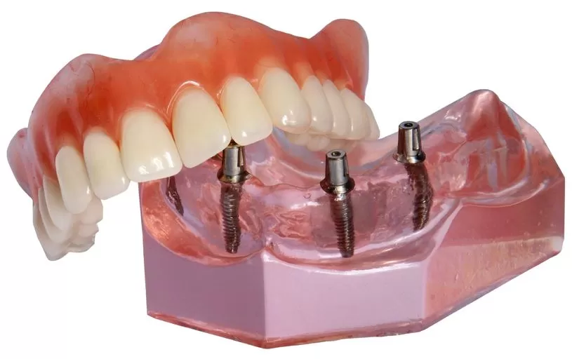 implanty zębów gdynia