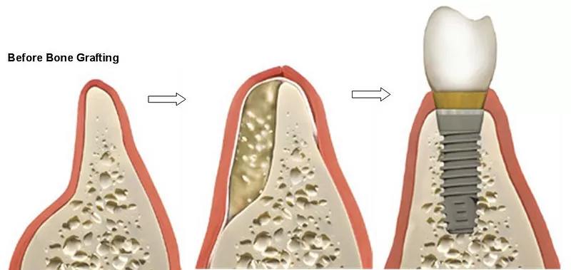 implanty zębów gdynia