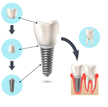 implant zęba gdynia