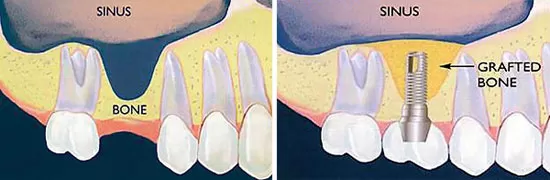 implanty zębów gdynia nowe orłowo